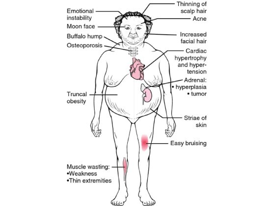 cushing_s-disease cushing_s-disease