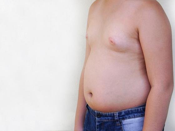 gynecomastia gynecomastia