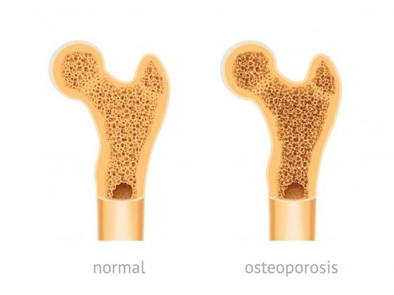 osteoporosis osteoporosis